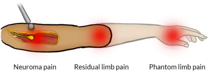 Douleur de névrome après amputation, d’après Pettersen et al., Trials, 2023