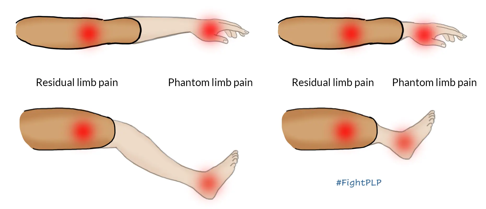 post-amputation pain
