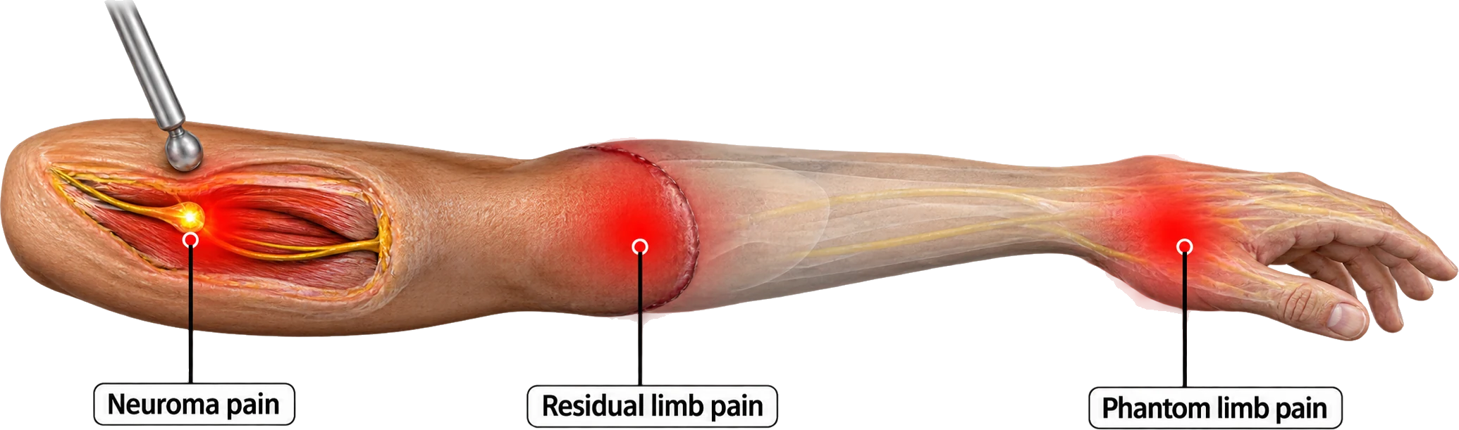 Dolore da neuroma dopo l’amputazione, da Pettersen et al., Trials, 2023