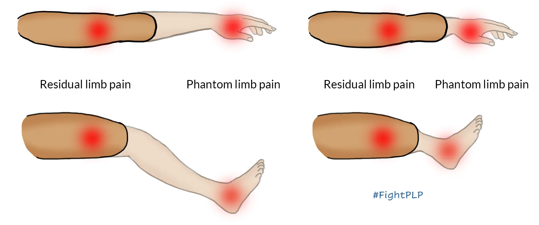 post-amputation pain